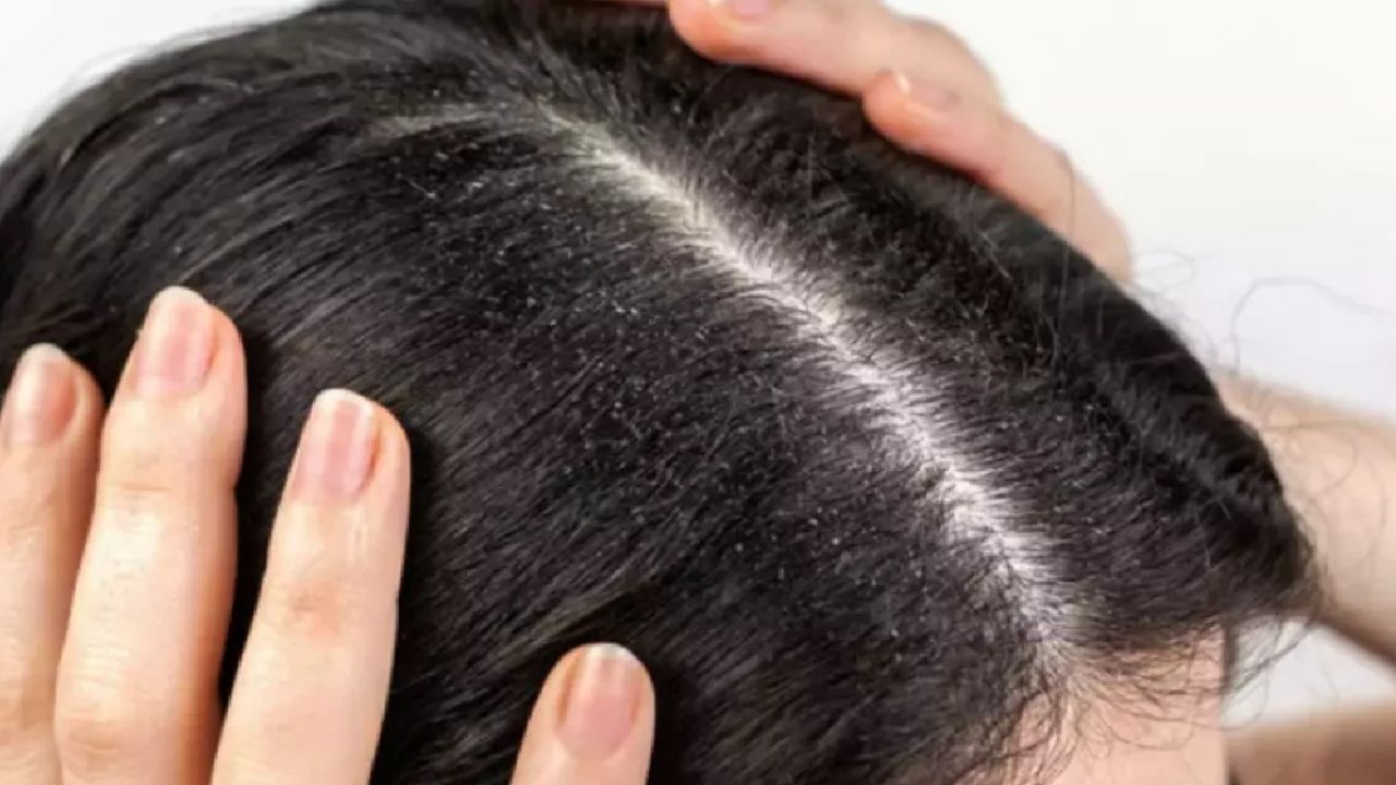 Saçlarında kepek sorunu olanlar dikkat: Nörolojik hastalığın belirtisi çıktı